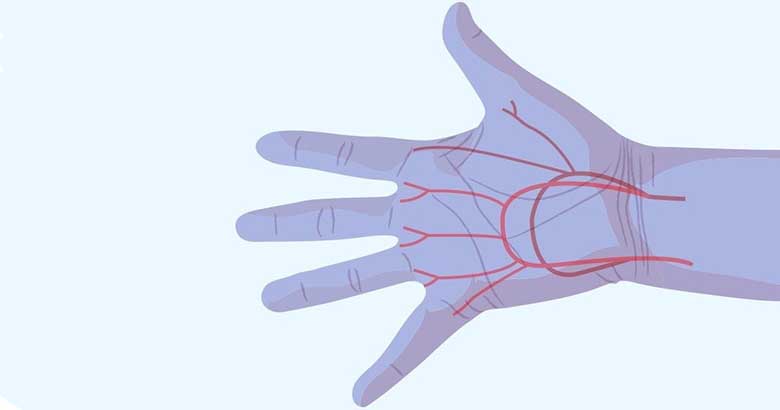 Динамика кровоснабжения пальцев кисти у больных с открытой травмой кисти в процессе гипербарической оксигенации при лечении с использованием минификсатора Илизарова