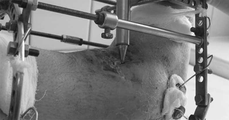 Реакция сосудистого русла поврежденных тканей на гипербарическую оксигенацию при лечении больных с открытыми переломами конечностей по методу Илизарова