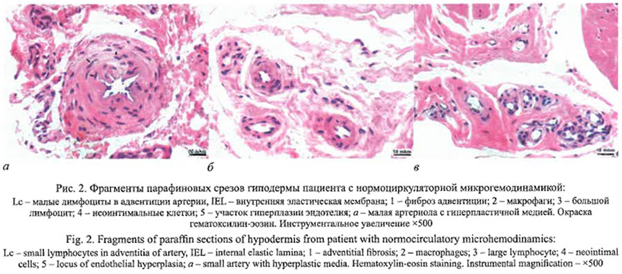 Морфофизиологические характеристики типов микроциркуляции кожи у пациентов с контрактурой Дюпюитрена