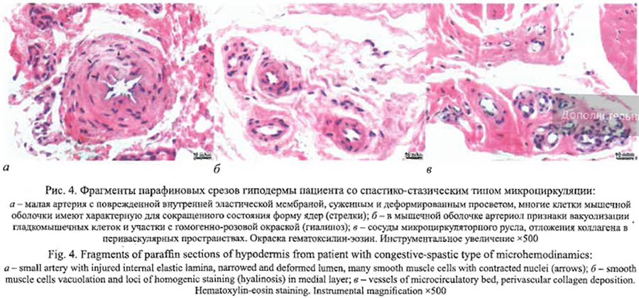 Морфофизиологические характеристики типов микроциркуляции кожи у пациентов с контрактурой Дюпюитрена