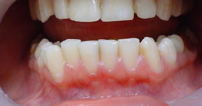 Применение лазерного излучения для коррекции слизистой оболочки преддверия полости рта