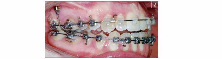 Ультразвуковая допплерография в диагностике сосудистых изменений пульпы вертикально перемещаемых зубов с опорой на мини-имплантаты