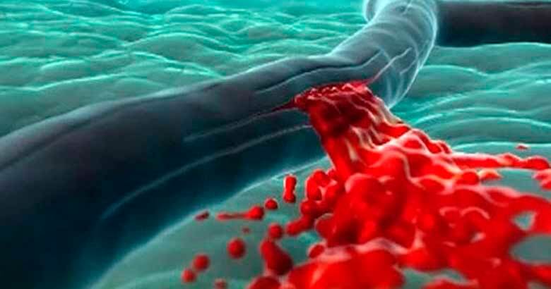Ультразвуковая допплерография в диагностике объема кровопотери
