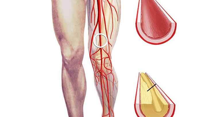 Нарушения микроциркуляции в тканях нижних конечностей у больных с синдромом диабетической стопы