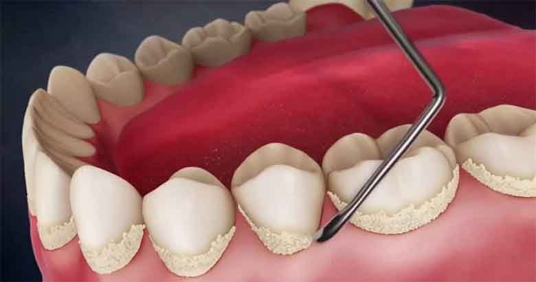 Исследование микроциркуляции тканей пародонта и пульпы зуба до и после удаления зубных отложений электрическими скейлерами