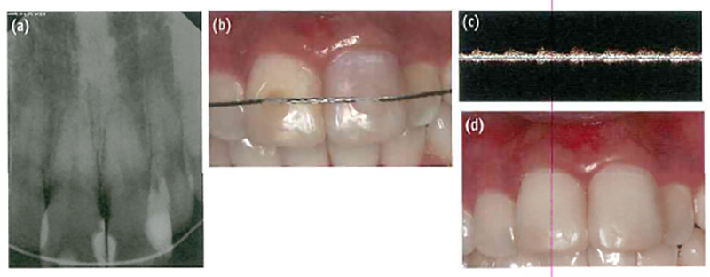 Использование ультразвуковой допплерографии для определения жизнеспособности потемневшего зуба после травматического повреждения: перспективы и ограничения