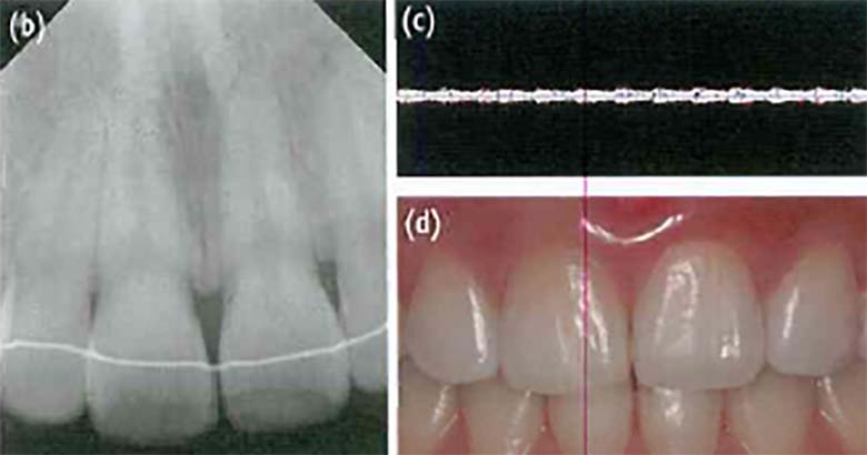 Использование ультразвуковой допплерографии для определения жизнеспособности потемневшего зуба: Изменение цвета зуба, жизнеспособность зуба, травматическое повреждение, ультразвуковая допплерография