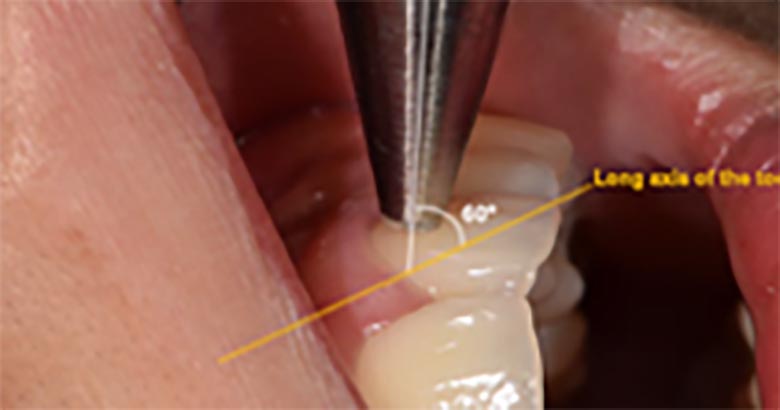 Влияние возраста, пола и кровяного давления на скорость кровотока в зубной пульпе, измеренное методом ультразвуковой допплерографии